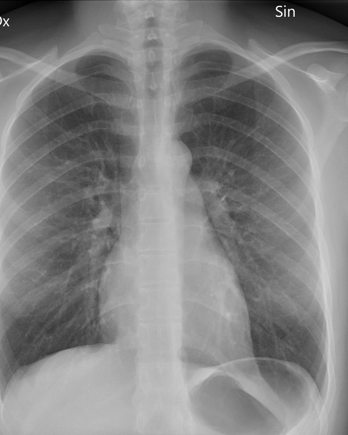 Chest X-ray radiograph on a light box